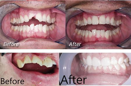 mediDental care | All-on-4 reg , Periodontal Treatment and Full Arch Dental Implant