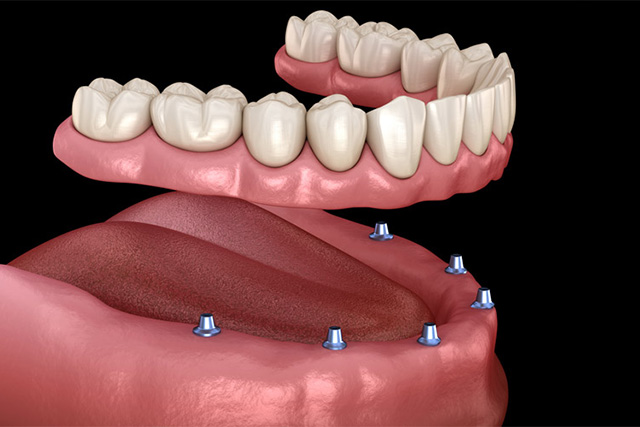 mediDental care | Full Arch Dental Implant, Dental Bridges and Implant Restorations