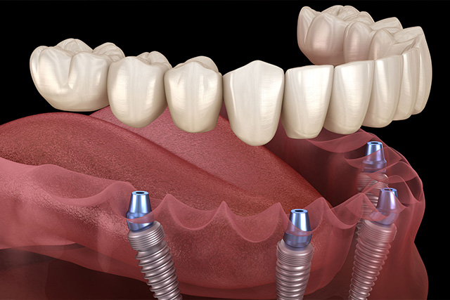 mediDental care | Root Canals, Dental Bridges and Periodontal Treatment