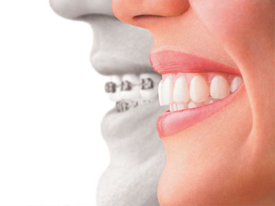 Invisalign Dentist in Astoria