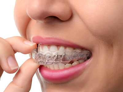 Invisalign Dental Office in Astoria